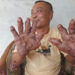 Sudah Belasan Tahun, Pria Ini Diserang Penyakit Kulit Aneh